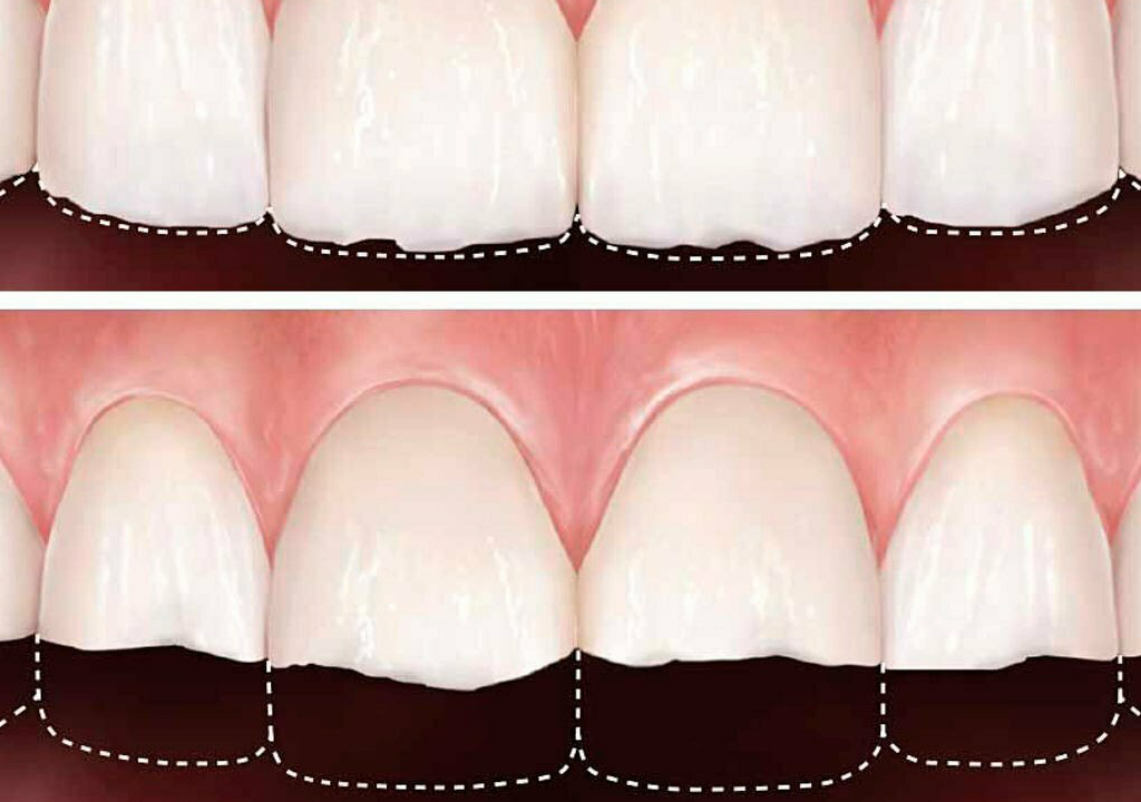 Abrasión Dental | Causas, prevención y tratamientos profesionales