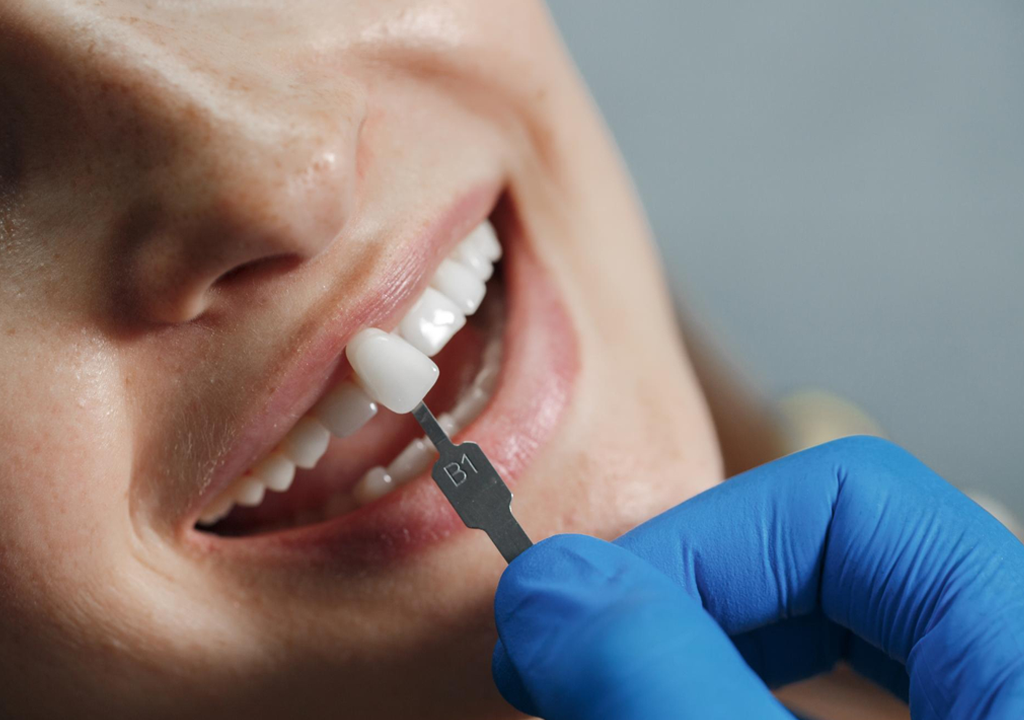 Microcarillas: ventajas y desventajas de una solución estética avanzada