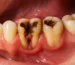 Primer plano de los dientes de un paciente adulto que necesita tratamiento para reparar dientes podridos