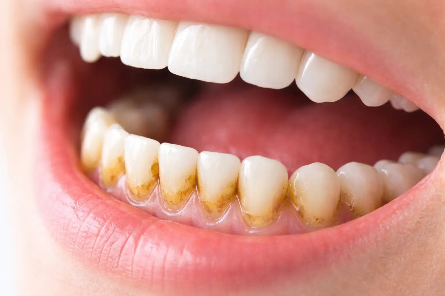 Dientes con sarro acumulado en la línea de las encías por placa bacteriana